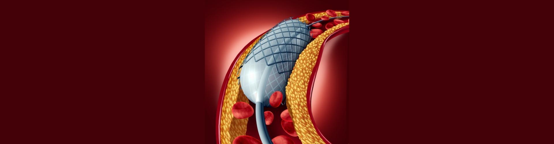 Stent
