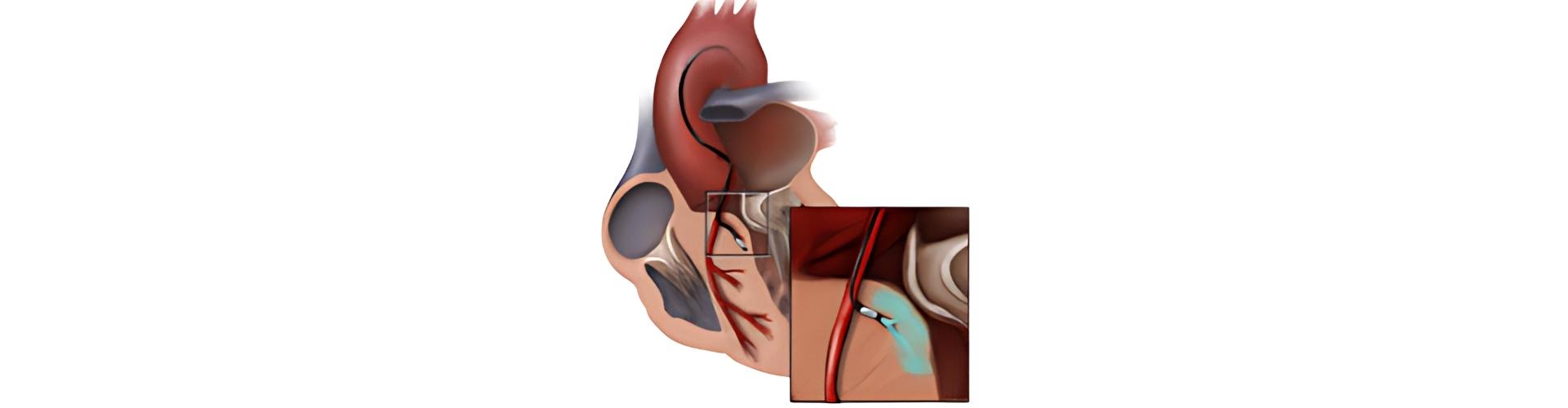 Alkol Septal Ablasyon