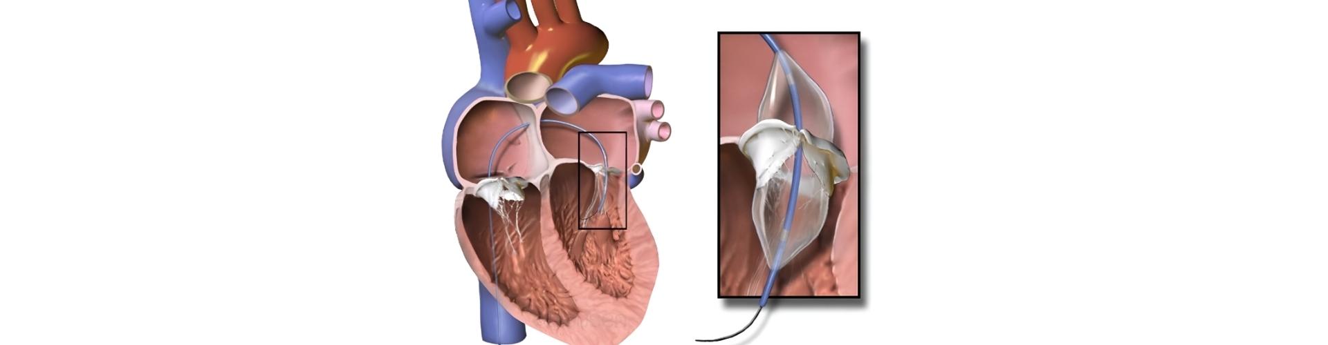 Mitral Balon